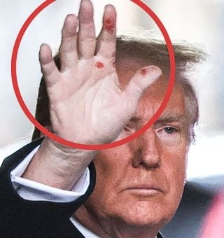 Experts Comment on Donald Trump’s Red Spots—What Could Be Behind Them