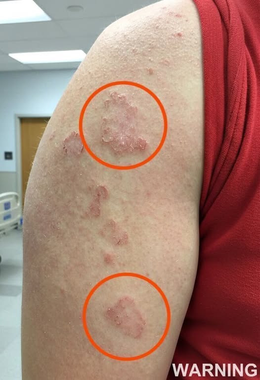 If you see red marks appearing on your arm, that’s a sign of ca…