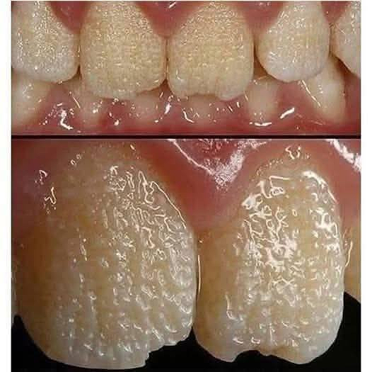 Be careful!! This is what your teeth will become when you eat