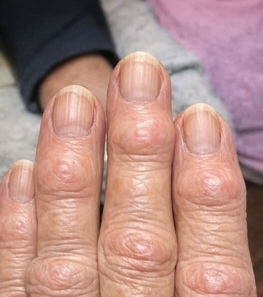 Finger Joint Bumps Near Nails: Common Causes and What to Watch For