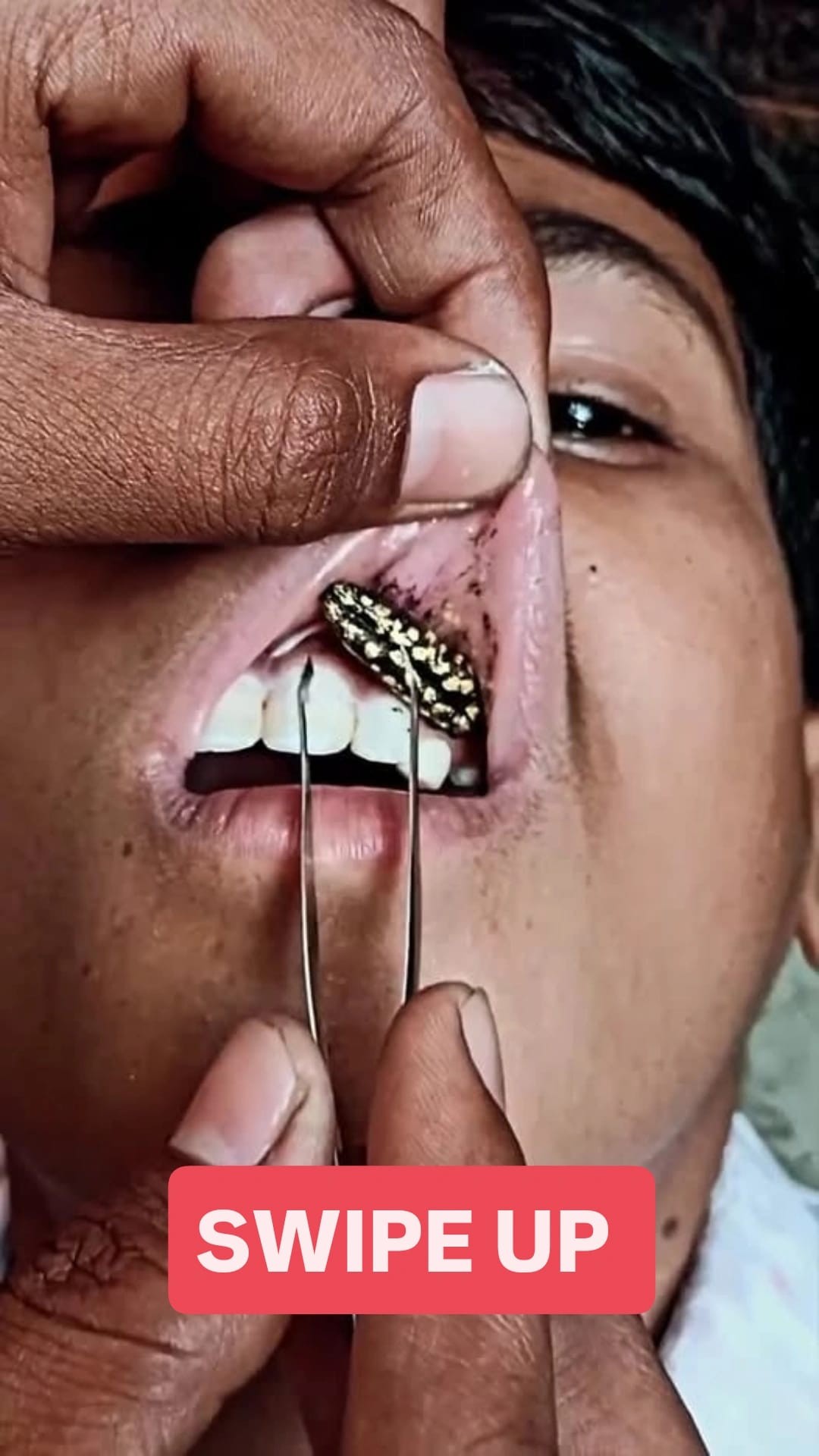 Horrible What They Found In This Mans mouth