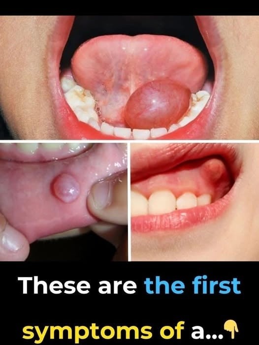 Hidden Dangers in Your Mouth: Early Signs of Oral…