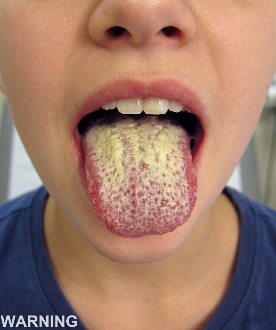 This could be happening to you if you have a white tongue and…