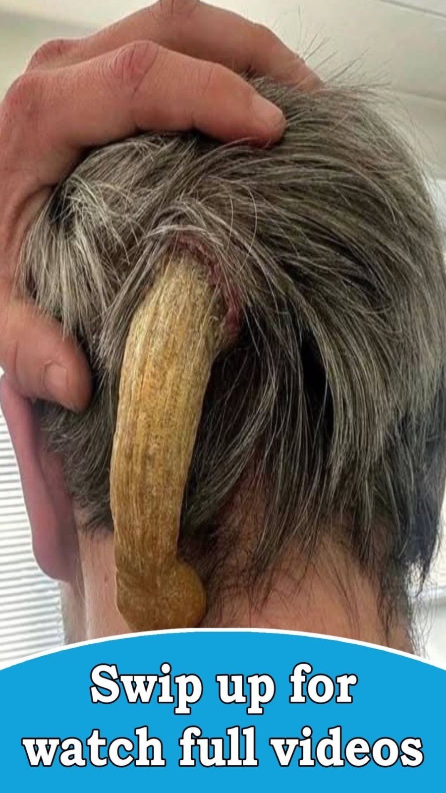 What Doctors Found Growing On The Back Of His Head Left Everyone Speechless