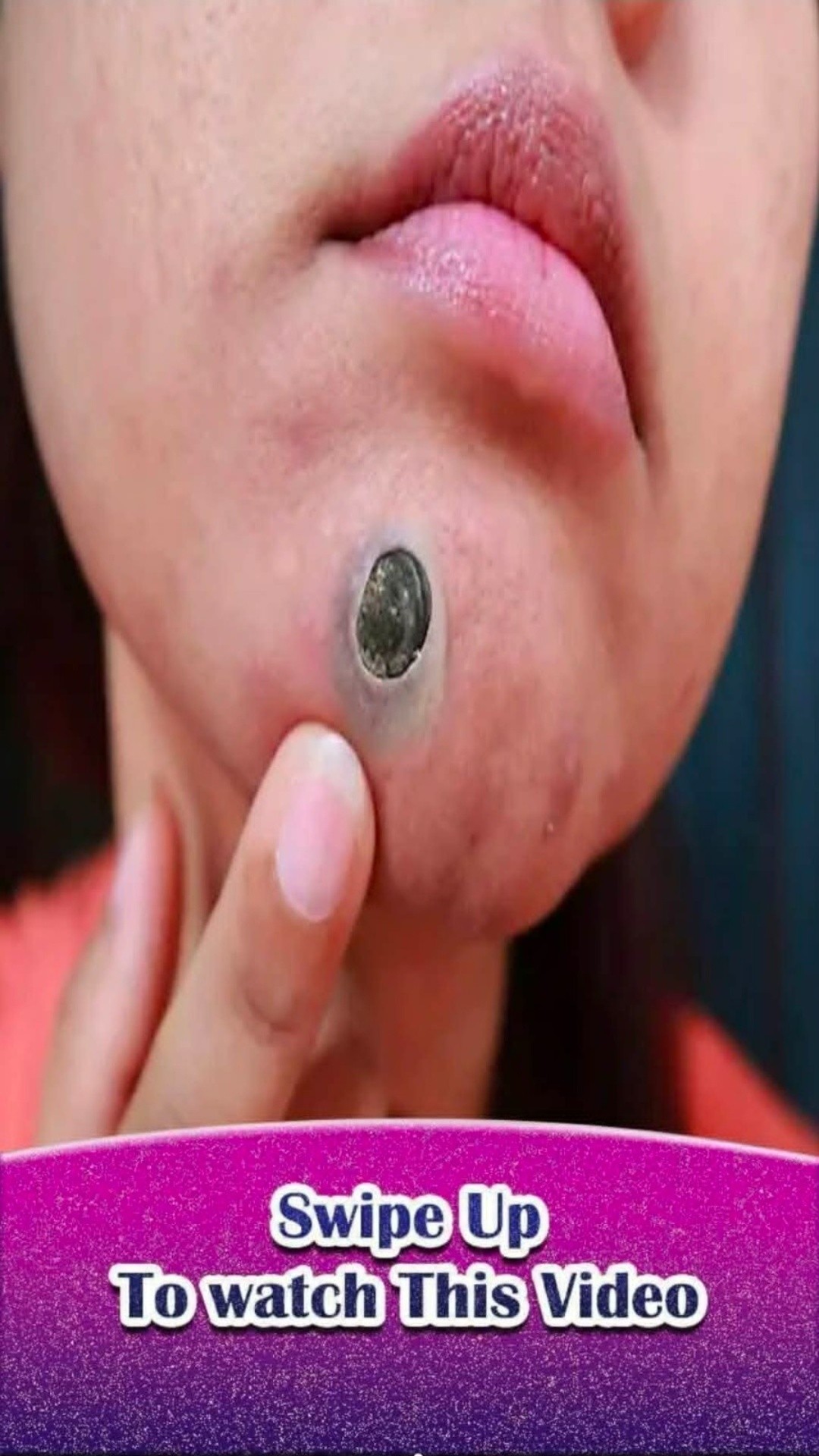 I Thought It Was Just A Pimple — Until It Got Worse