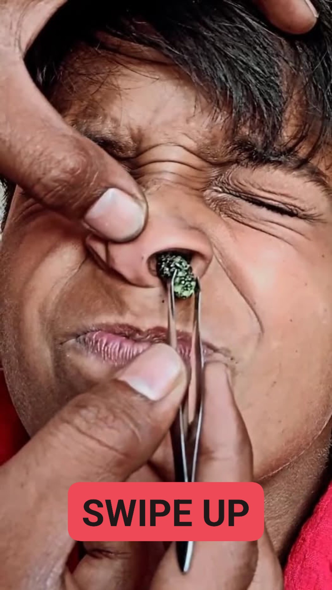 Horrifying Discovery: Doctors Stunned by What Was Hidden Inside His Nose